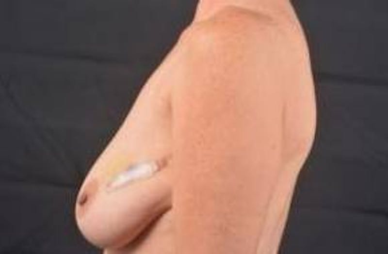 Immediate Breast Reconstruction – Skin Sparing Before & After Gallery - Patient 650936 - Image 3