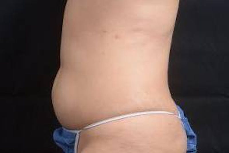 360 Liposuction Before & After Gallery - Patient 292763 - Image 3