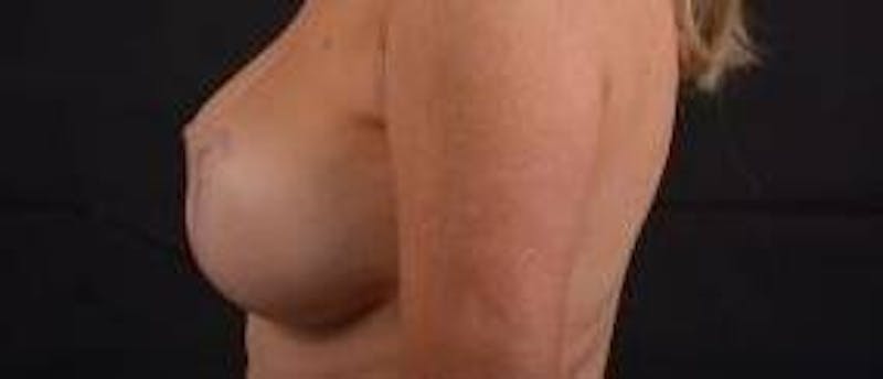 Aesthetic Breast Revision Before & After Gallery - Patient 101391 - Image 3