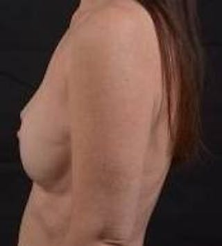 Immediate Breast Reconstruction – Nipple Sparing Before & After Gallery - Patient 148509 - Image 4