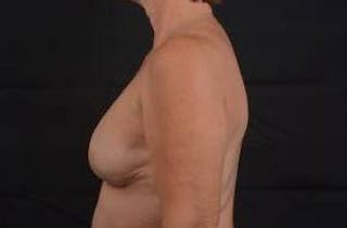 Immediate Breast Reconstruction – Skin Sparing Before & After Gallery - Patient 650936 - Image 4