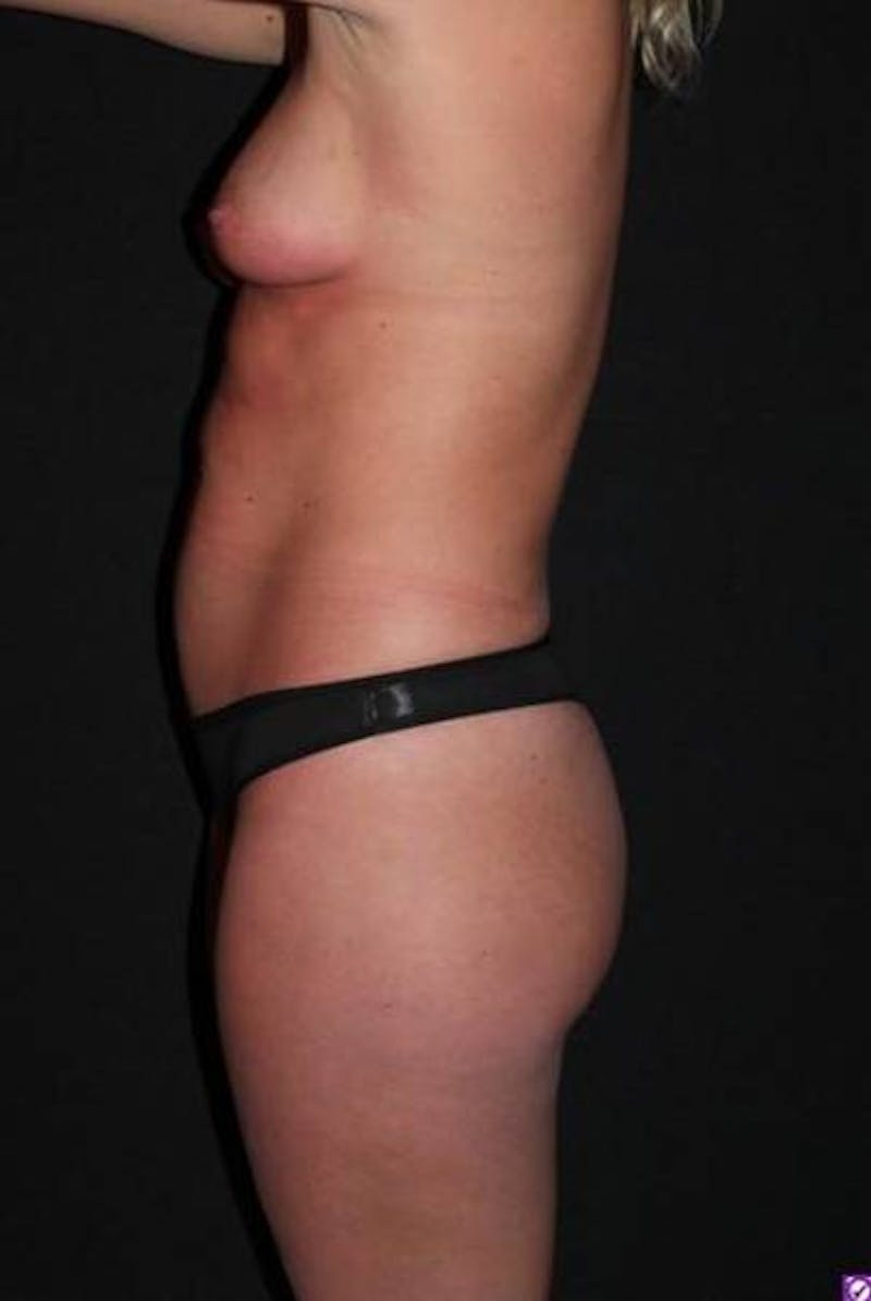 Mommy Makeover Before & After Gallery - Patient 184962 - Image 5