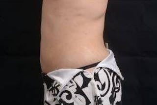 360 Liposuction Before & After Gallery - Patient 292763 - Image 4