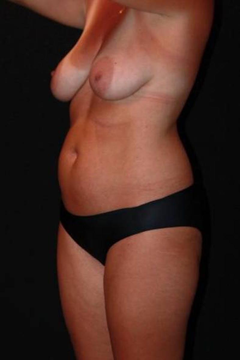 Abdominoplasty Before & After Gallery - Patient 353271 - Image 3