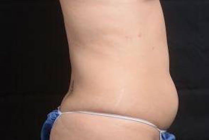 360 Liposuction Before & After Gallery - Patient 292763 - Image 5