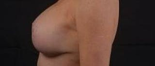 Aesthetic Breast Revision Before & After Gallery - Patient 101391 - Image 4