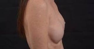 Immediate Breast Reconstruction – Nipple Sparing Before & After Gallery - Patient 148509 - Image 6