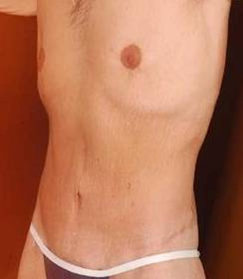 Mastopexy Before & After Gallery - Patient 671175 - Image 4