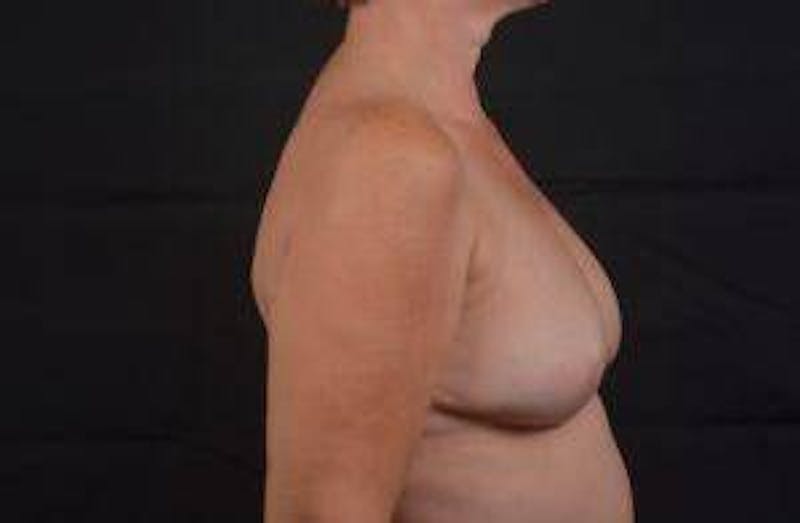 Immediate Breast Reconstruction – Skin Sparing Before & After Gallery - Patient 650936 - Image 6