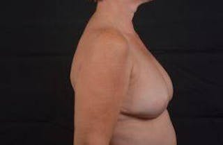 Immediate Breast Reconstruction – Skin Sparing Before & After Gallery - Patient 650936 - Image 6