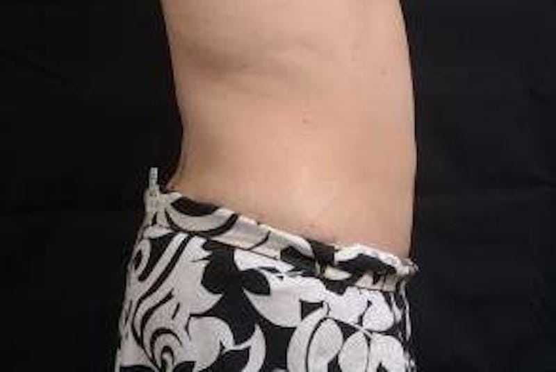 360 Liposuction Before & After Gallery - Patient 292763 - Image 6