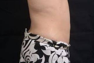 360 Liposuction Before & After Gallery - Patient 292763 - Image 6