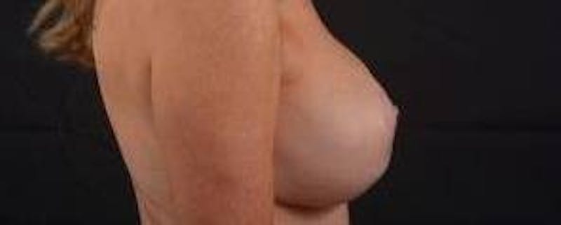 Aesthetic Breast Revision Before & After Gallery - Patient 101391 - Image 5