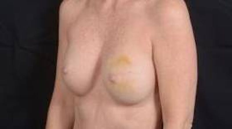 Immediate Breast Reconstruction – Nipple Sparing Before & After Gallery - Patient 148509 - Image 7