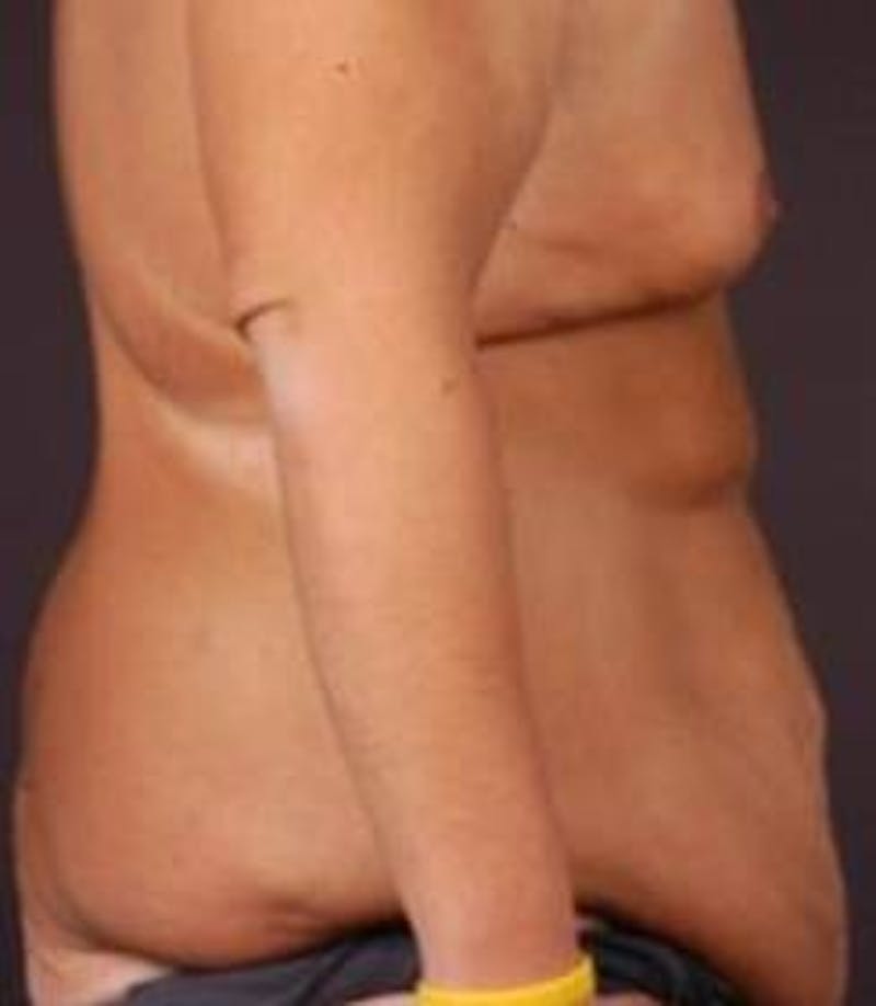 Mastopexy Before & After Gallery - Patient 671175 - Image 5