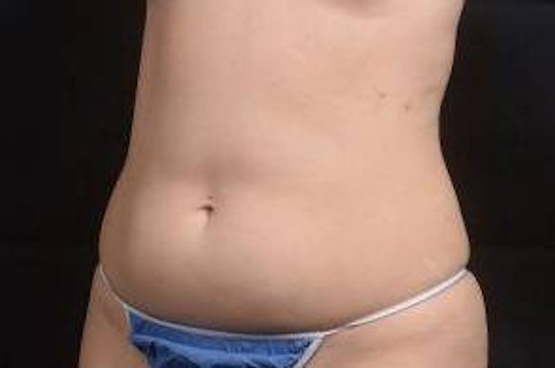 360 Liposuction Before & After Gallery - Patient 292763 - Image 7