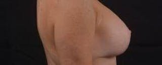 Aesthetic Breast Revision Before & After Gallery - Patient 101391 - Image 6