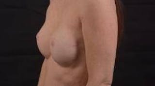 Immediate Breast Reconstruction – Nipple Sparing Before & After Gallery - Patient 148509 - Image 8