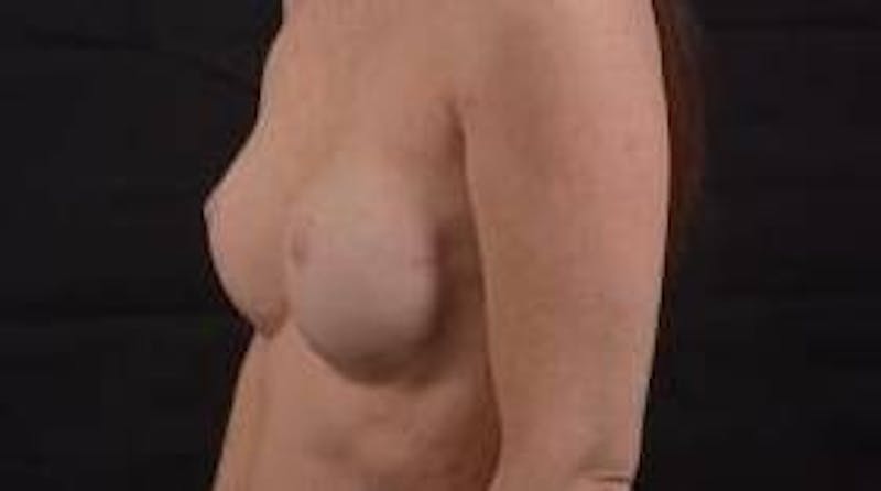 Immediate Breast Reconstruction – Nipple Sparing Before & After Gallery - Patient 148509 - Image 8