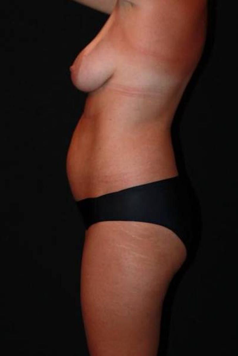Abdominoplasty Before & After Gallery - Patient 353271 - Image 5