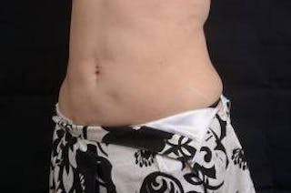 360 Liposuction Before & After Gallery - Patient 292763 - Image 8
