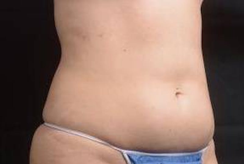 360 Liposuction Before & After Gallery - Patient 292763 - Image 9