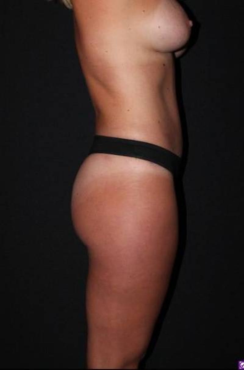 Mommy Makeover Before & After Gallery - Patient 184962 - Image 10