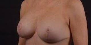 Aesthetic Breast Revision Before & After Gallery - Patient 101391 - Image 8
