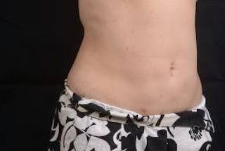 360 Liposuction Before & After Gallery - Patient 292763 - Image 10