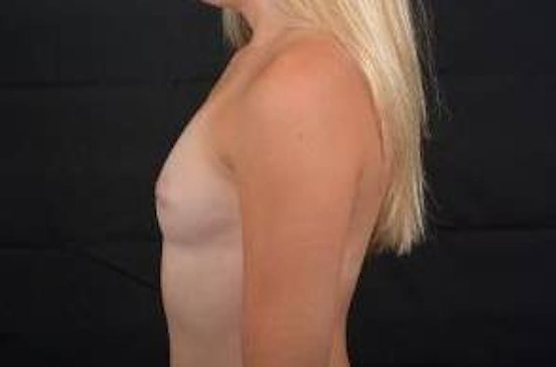 Breast Augmentation Silicone Gel Before & After Gallery - Patient 110850 - Image 3