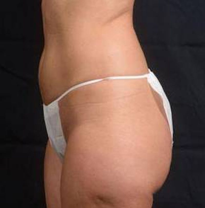 360 Liposuction Before & After Gallery - Patient 305550 - Image 3