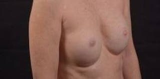 Immediate Breast Reconstruction – Nipple Sparing Before & After Gallery - Patient 148509 - Image 10