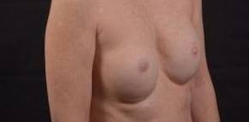 Immediate Breast Reconstruction – Nipple Sparing Before & After Gallery - Patient 148509 - Image 10