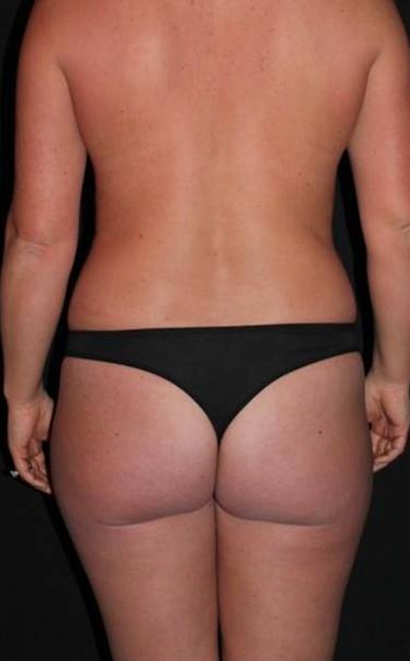 Mommy Makeover Before & After Gallery - Patient 184962 - Image 11