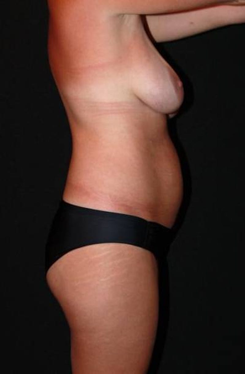 Abdominoplasty Before & After Gallery - Patient 353271 - Image 9