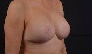 Aesthetic Breast Revision Before & After Gallery - Patient 101391 - Image 10