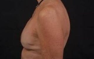 Immediate Breast Reconstruction – Skin Sparing Before & After Gallery - Patient 157047 - Image 4