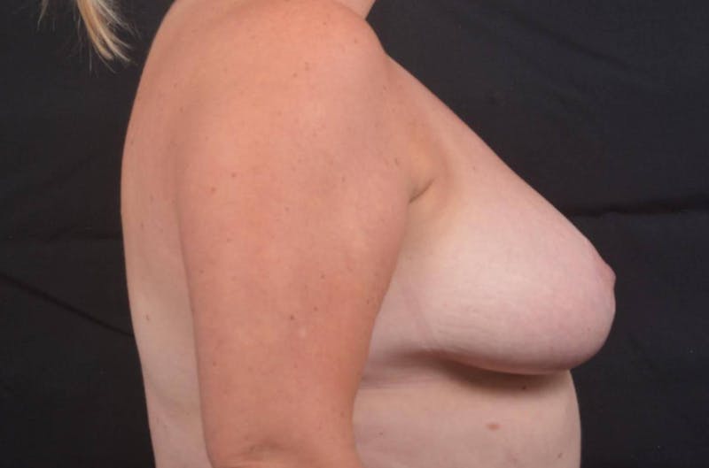 Mastopexy Before & After Gallery - Patient 383629 - Image 5