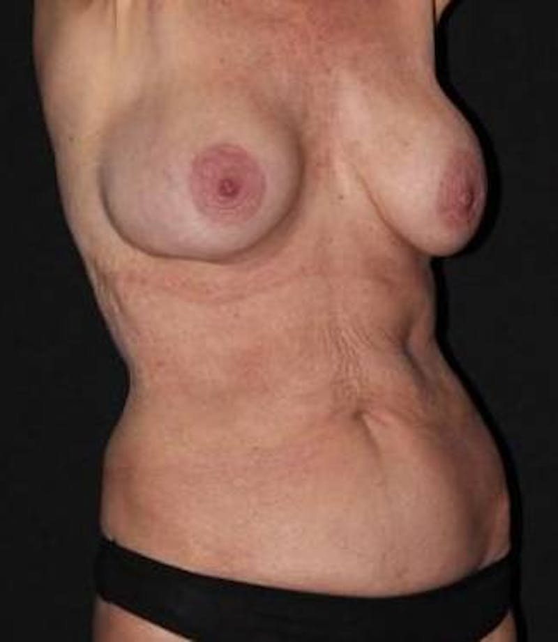 Mommy Makeover Before & After Gallery - Patient 309496 - Image 3