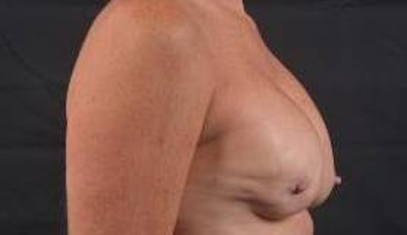 Immediate Breast Reconstruction – Skin Sparing Before & After Gallery - Patient 157047 - Image 5