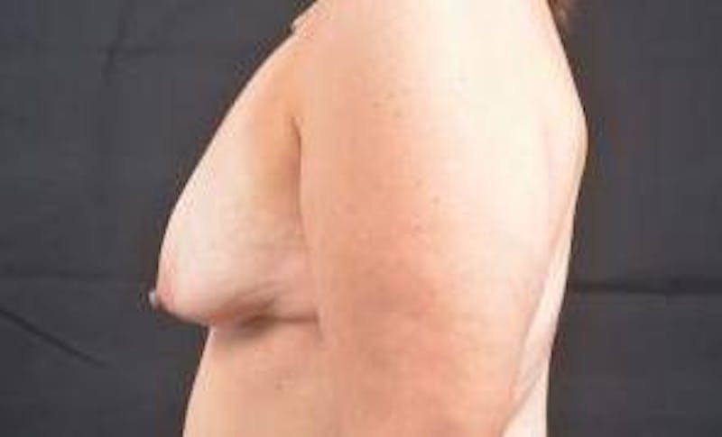 Breast Augmentation Silicone Gel Before & After Gallery - Patient 456880 - Image 3