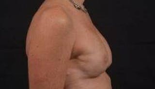 Immediate Breast Reconstruction – Skin Sparing Before & After Gallery - Patient 157047 - Image 6