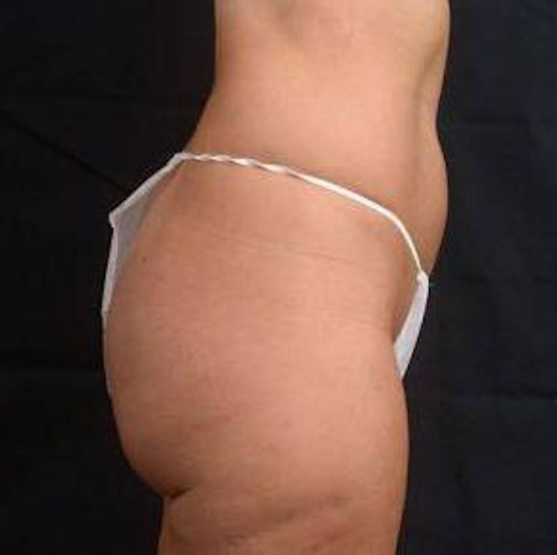 360 Liposuction Before & After Gallery - Patient 305550 - Image 5