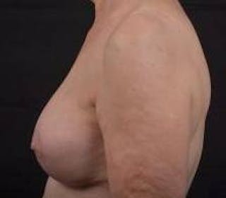 Aesthetic Breast Revision Before & After Gallery - Patient 281728 - Image 4