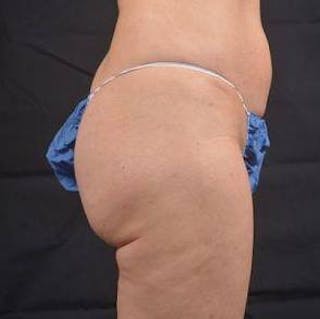 360 Liposuction Before & After Gallery - Patient 305550 - Image 6