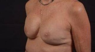 Immediate Breast Reconstruction – Skin Sparing Before & After Gallery - Patient 157047 - Image 8