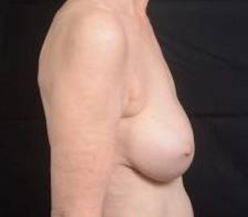 Aesthetic Breast Revision Before & After Gallery - Patient 281728 - Image 5