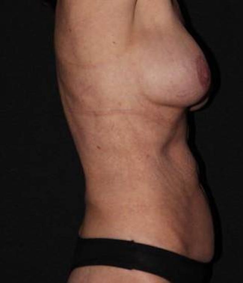 Mommy Makeover Before & After Gallery - Patient 309496 - Image 7