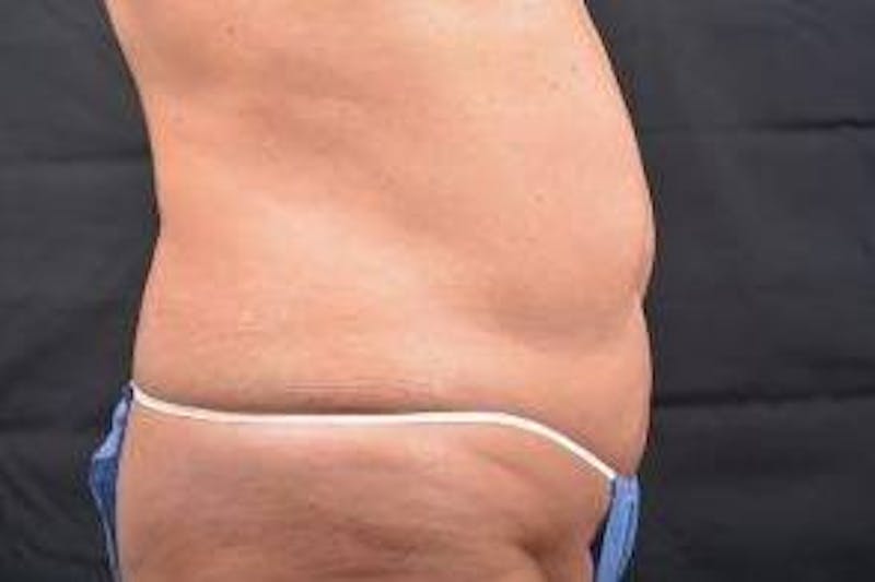 Abdominoplasty Before & After Gallery - Patient 410231 - Image 5