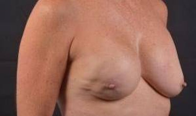 Immediate Breast Reconstruction – Skin Sparing Before & After Gallery - Patient 157047 - Image 9